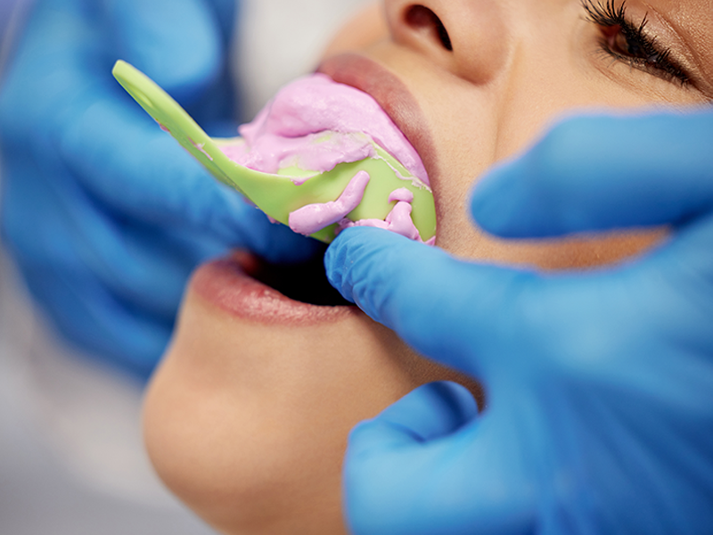 detal-alginate-impression-1